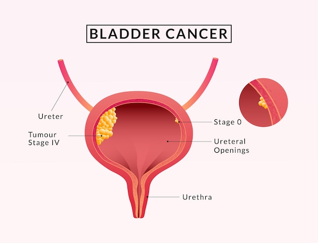 Cáncer de vejiga urinaria anatomía de la vejiga humana ilustración médica