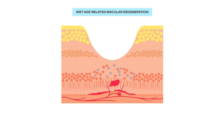 Vector cartel de degeneración macular