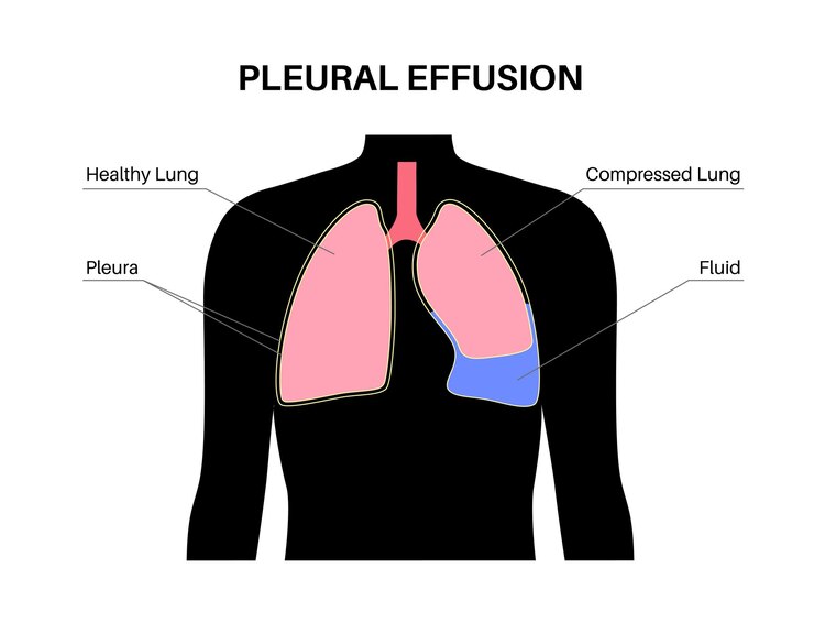 Vector cartel de derrame pleural