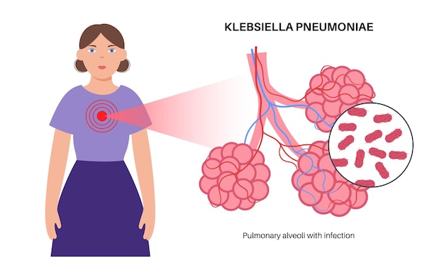 Cartel de la enfermedad de Klebsiella pneumoniae