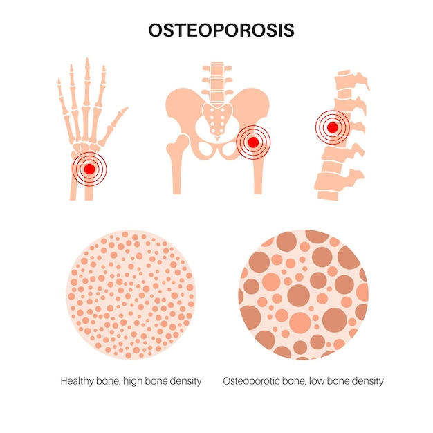 Cartel de enfermedad de osteoporosis Trastorno esquelético sistémico de la columna vertebral, la muñeca y el fémur
