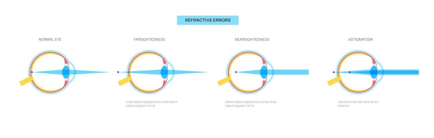 Vector cartel de errores de refracción