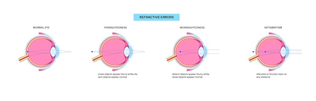 Vector cartel de errores de refracción