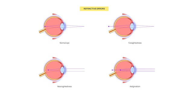 Vector cartel de errores de refracción