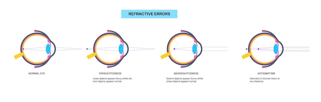 Vector cartel de errores de refracción