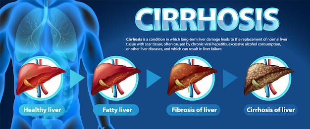 Cartel informativo de la enfermedad hepática alcohólica Cirrosis