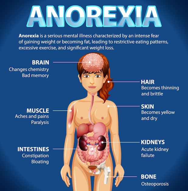 Cartel informativo del trastorno alimentario por anorexia