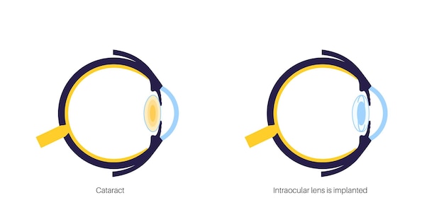 Cartel de lentes intraoculares