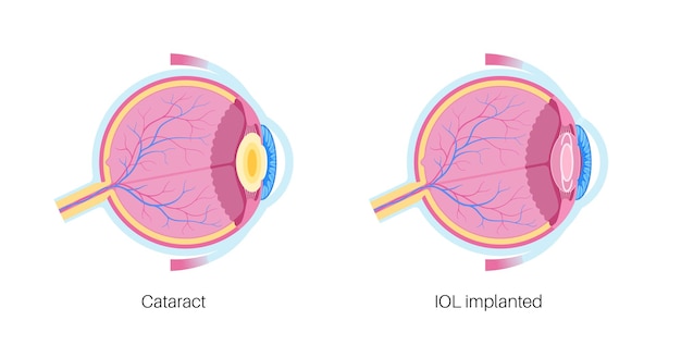 Cartel de lentes intraoculares