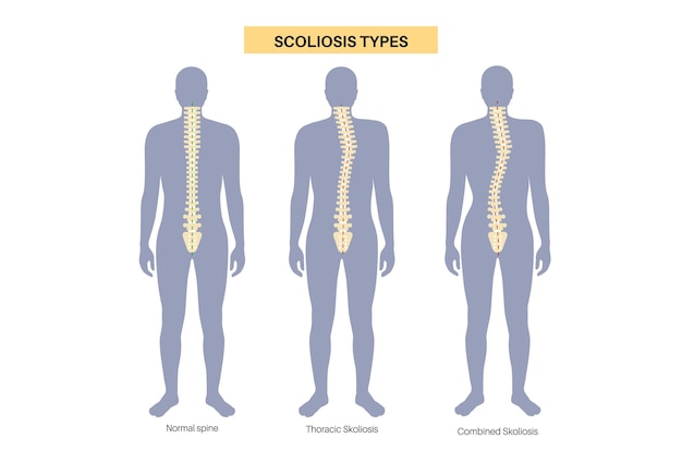 Cartel médico para la escoliosis