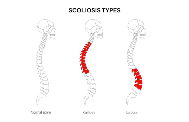 Cartel médico para la escoliosis