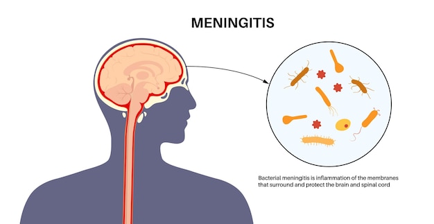 Cartel médico para la meningitis
