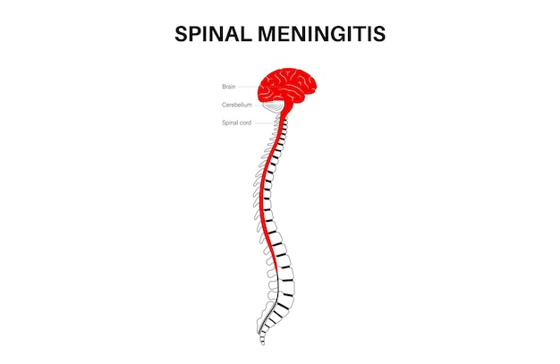 Cartel de meningitis espinal