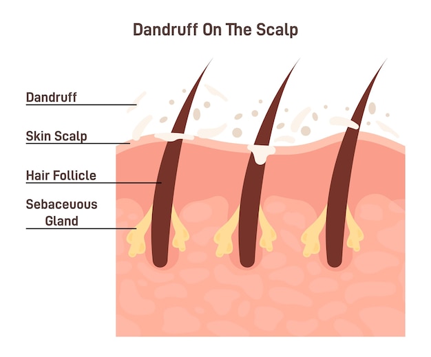 Vector caspa escamas de piel en el cuero cabelludo seco y con picazón corte transversal de la piel