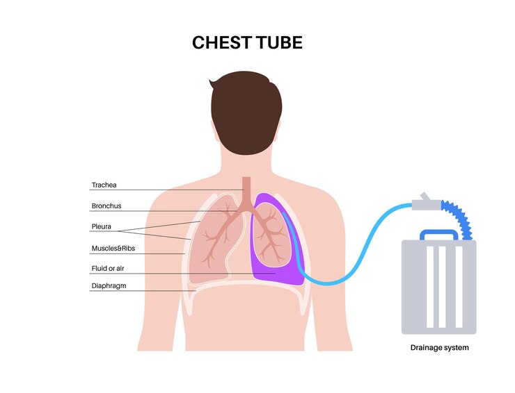 Vector catéter de tubo torácico