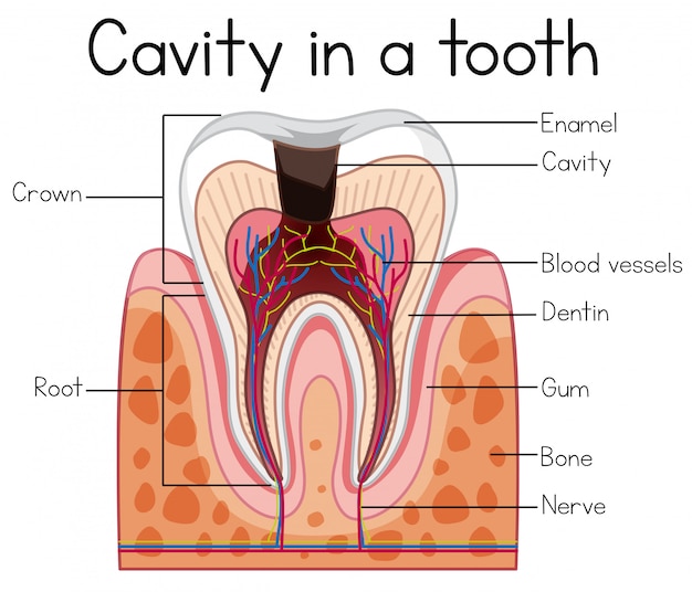 Vector cavidad en un diente