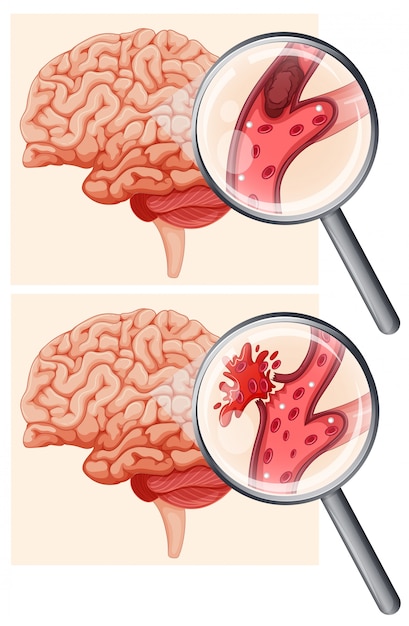 Vector cerebro humano y accidente cerebrovascular hemorrágico