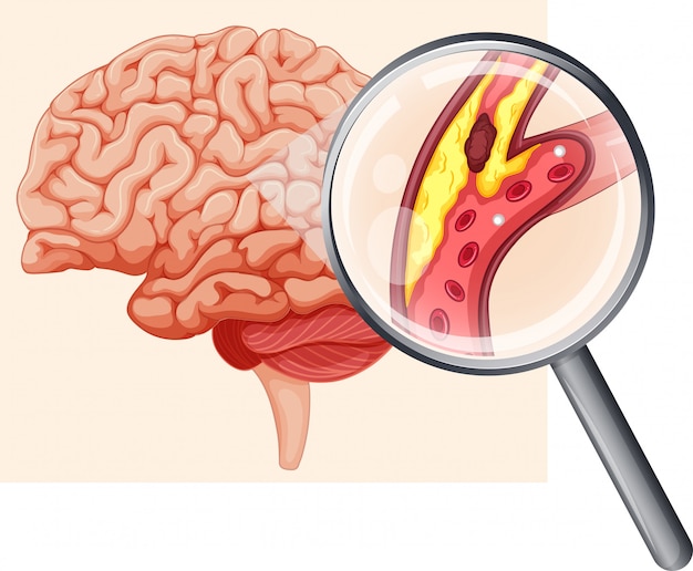 Cerebro humano con aterosclerosis