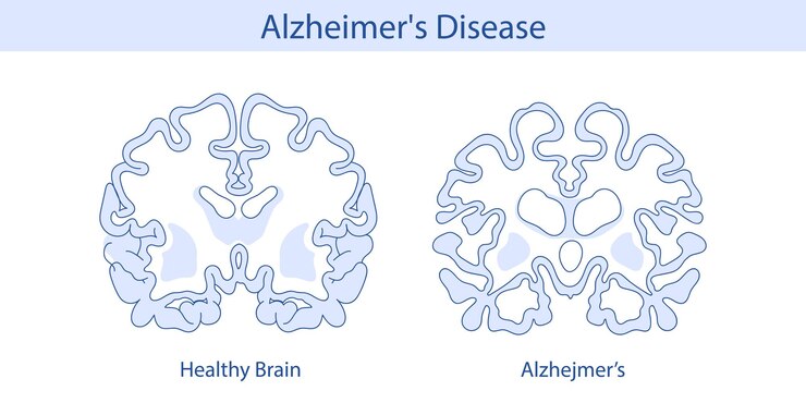 Vector cerebro sano y cerebro con enfermedad de alzheimer39 ilustración dibujada a mano