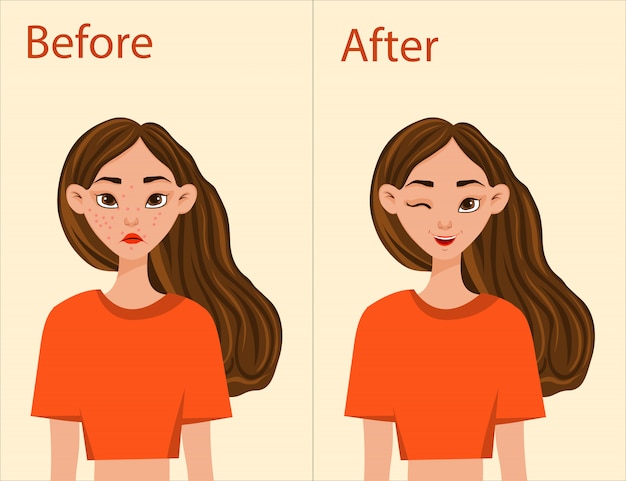 Chica antes y después del tratamiento del acné. Estilo de dibujos animados. ilustración.