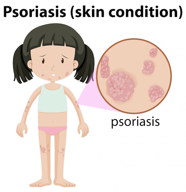 Una chica havimg psoriasis en la piel