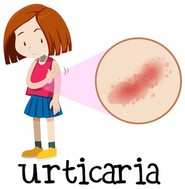 Vector una chica joven que tiene urticaria