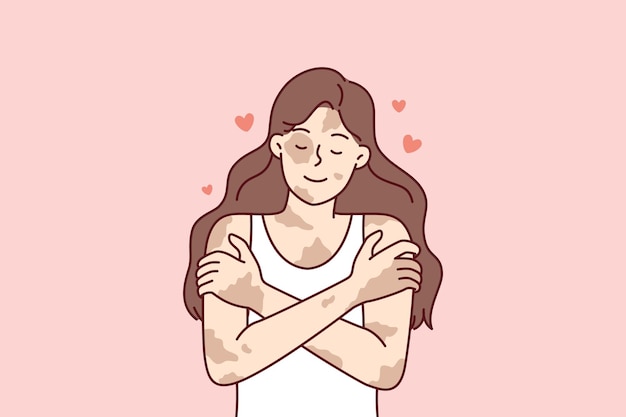 Chica positiva con enfermedad de vitíligo abrazándose a sí misma tomando enfermedades de la piel como característica personal