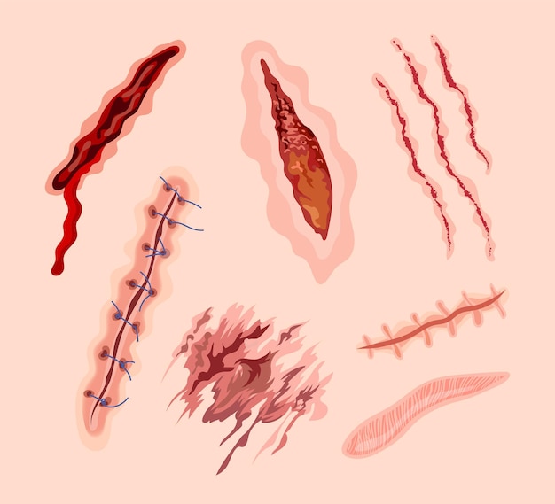 Vector cicatrices en la piel con conjunto de ilustración de dibujos animados de puntadas. herida sangrienta, lesiones, rasguños, hematomas, suturas quirúrgicas en piernas o brazos. cortes en la piel o dolor después de la operación. salud, concepto de medicina