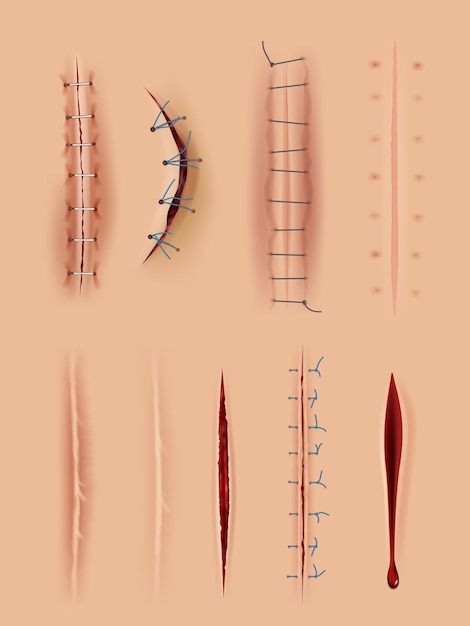 Cicatrices realistas Suturas quirúrgicas médicas heridas cierran imágenes en la piel humana conjunto de ilustraciones vectoriales decentes