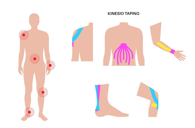 Cinta terapéutica elástica cinta de kinesiología en el hombro de la pierna del brazo y el abdomen tira elástica del método kt supuestamente para aliviar el dolor de las lesiones protección para la ilustración vectorial de músculos y ligamentos