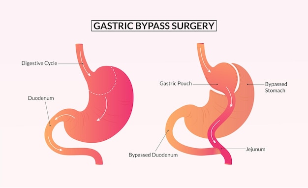 Cirugía de bypass gástrico antes y después de la ilustración médica