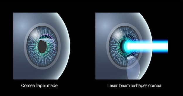Cirugía ocular LASIK