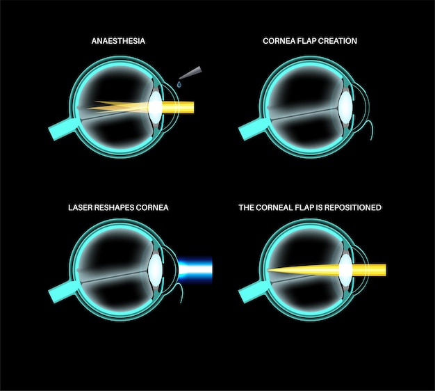 Cirugía ocular LASIK