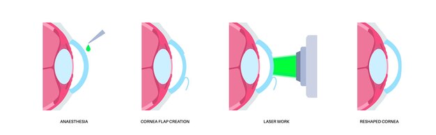 Cirugía ocular LASIK