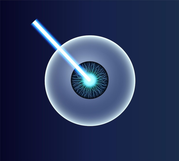 Vector cirugía ocular lasik