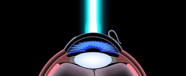 Cirugía ocular LASIK