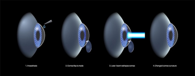 Cirugía ocular LASIK