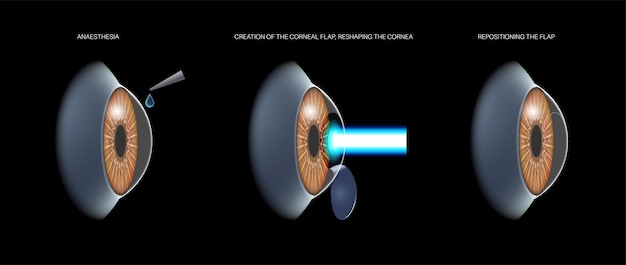 Cirugía ocular LASIK