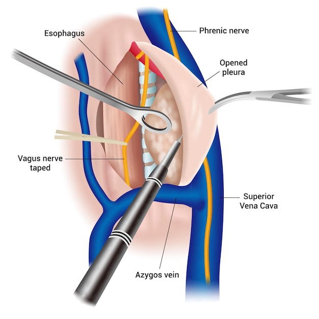 Vector cirugía de tórax para extirpación de tumores