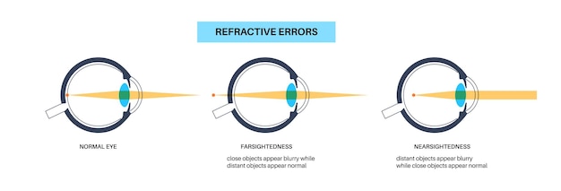 Vector la clarividencia y la miopía