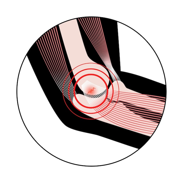 Codo de golfista con epicondilitis medial