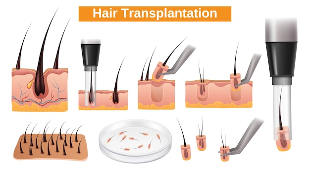 Vector colección realista de conjuntos de elementos para el trasplante de cabello