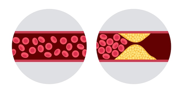 Colesterol y aterosclerosis