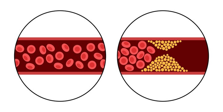 Vector colesterol y aterosclerosis