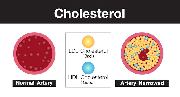El colesterol en el diseño del vector de riesgo para la salud arterial