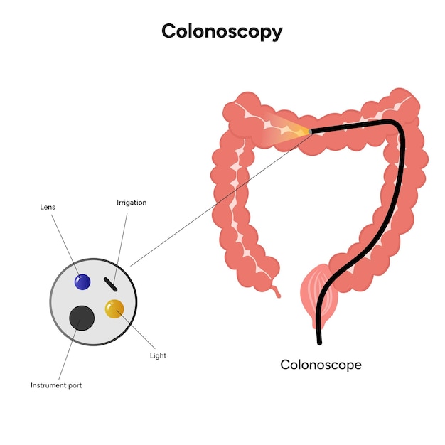 Colonoscopia y colonoscopio
