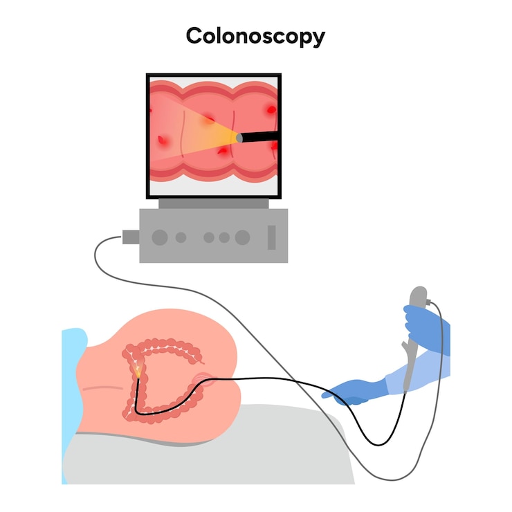 Vector colonoscopia y colonoscopio