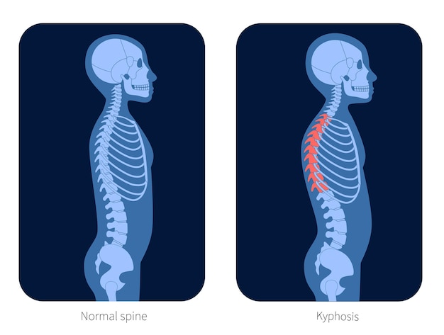 Vector columna vertebral normal y cifosis en el cuerpo del niño. ilustración de vector plano de rayos x. anatomía de la columna vertebral y el esqueleto en silueta de niño. cartel ortopédico. banner médico para clínica. examen en el centro de dolor espinal