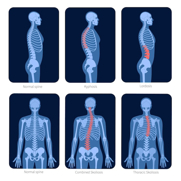 Columna vertebral normal y tipos de defectos de la columna. Escoliosis en el cuerpo humano. Ilustración de vector plano de rayos X. Anatomía de la columna vertebral y el esqueleto en silueta de hombre. Cartel ortopédico. Examen médico en el centro de dolor espinal