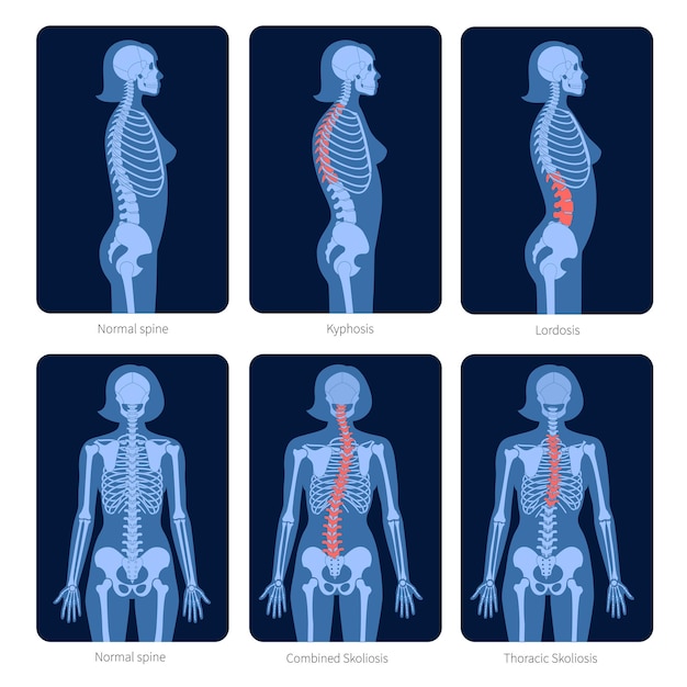 Columna vertebral normal y tipos de defectos de la columna. Escoliosis en el cuerpo de la mujer. Ilustración de vector plano de rayos X. Espina dorsal, anatomía del esqueleto en silueta femenina. Cartel ortopédico. Examen médico en el centro de dolor espinal